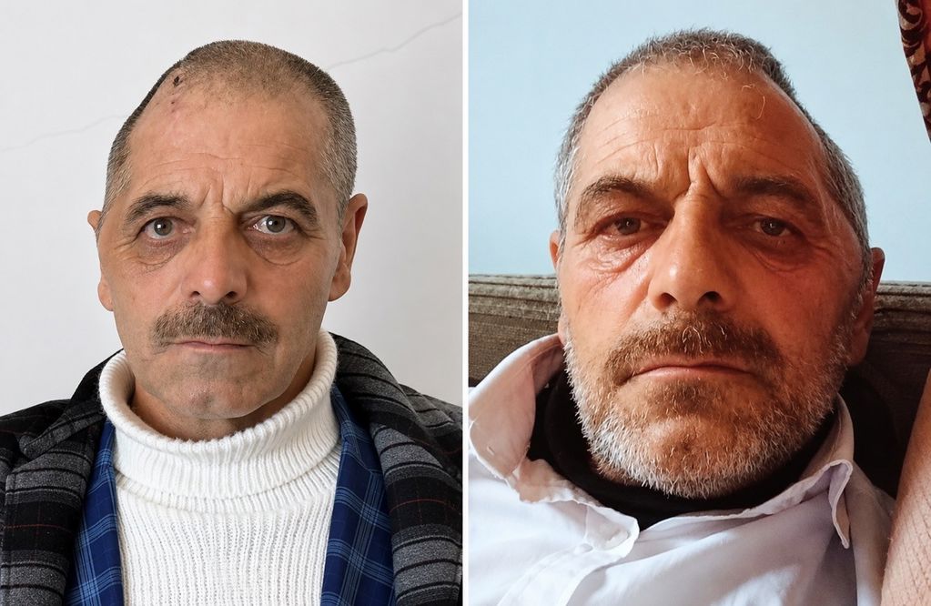 Ağrı’da İlk Kez Sentetik Kafatası Ameliyatı Yapıldı: Beyin Apsesi Nedeniyle Alınan Kemik Yeniden Oluşturuldu