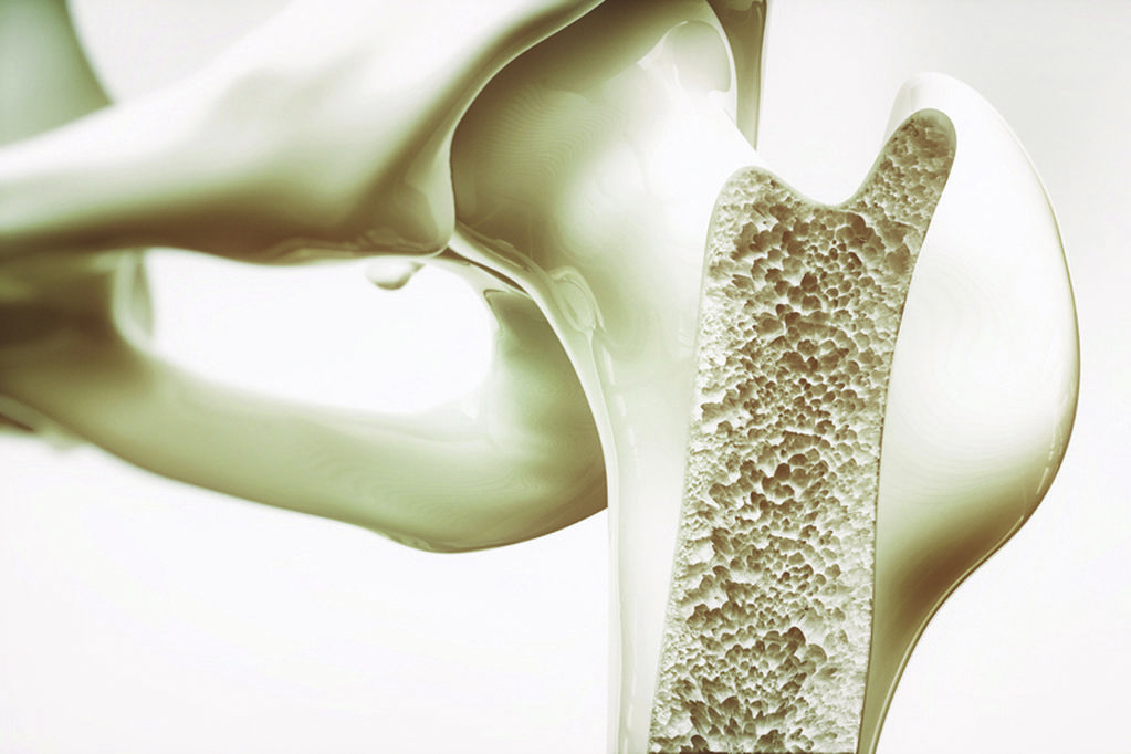 Osteoporoz Kırık Oluşana Kadar Sessiz İlerliyor: Uzmandan Kemik Sağlığı Uyarısı